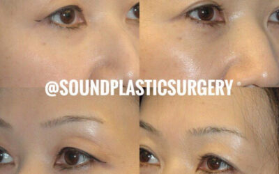 Seeing the Benefits of Blepharoplasty
