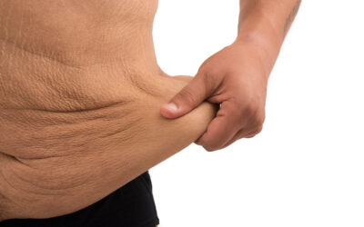 Body contouring following major weight loss