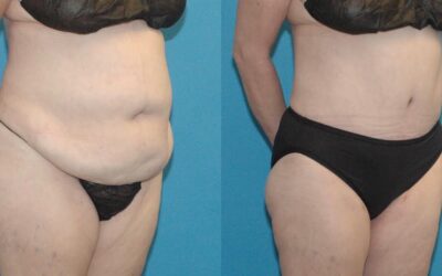 Liposuction Tummy Tuck combo
