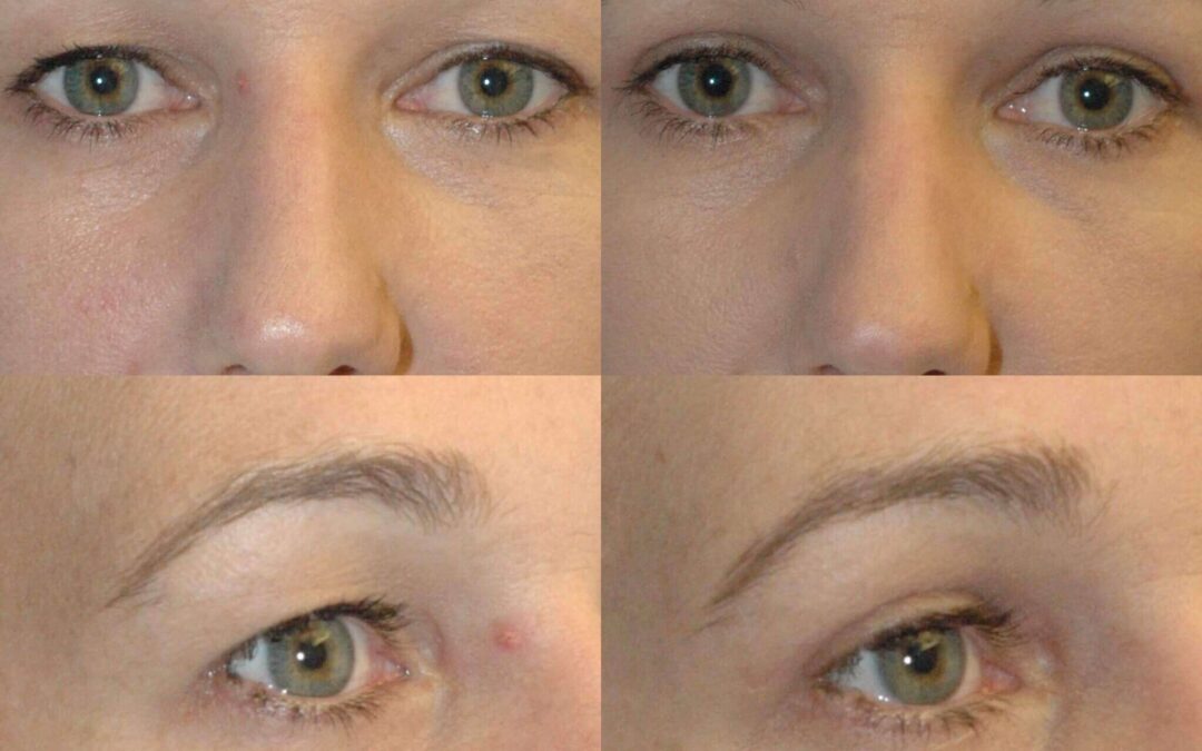 Eyelid Lifts