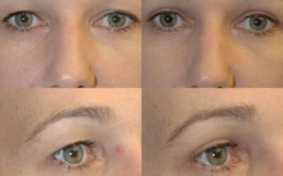 Eyelid Lifts