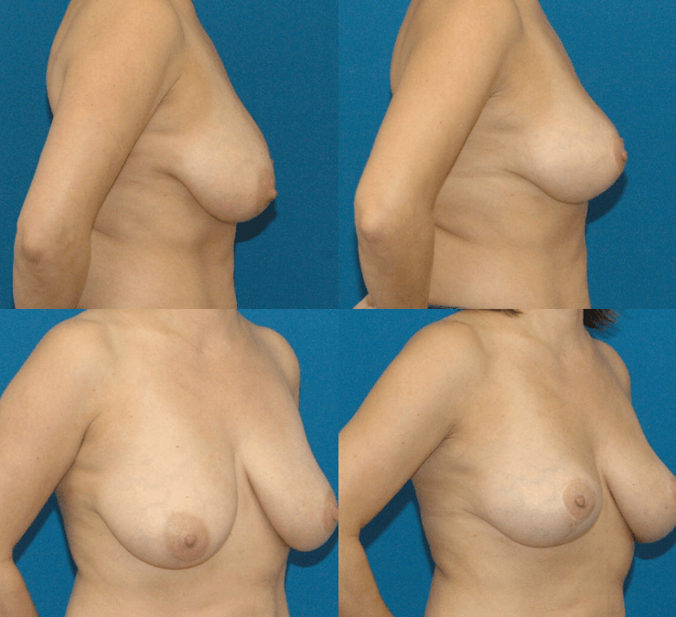 Breast Lift or Mastopexy