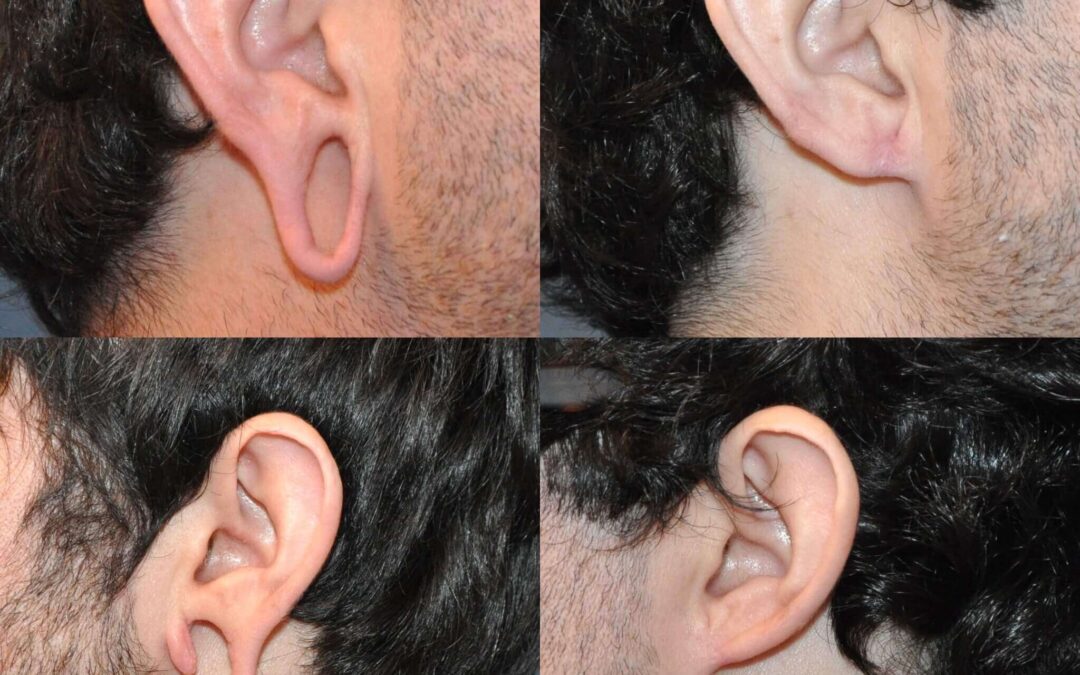 Earlobe Repair