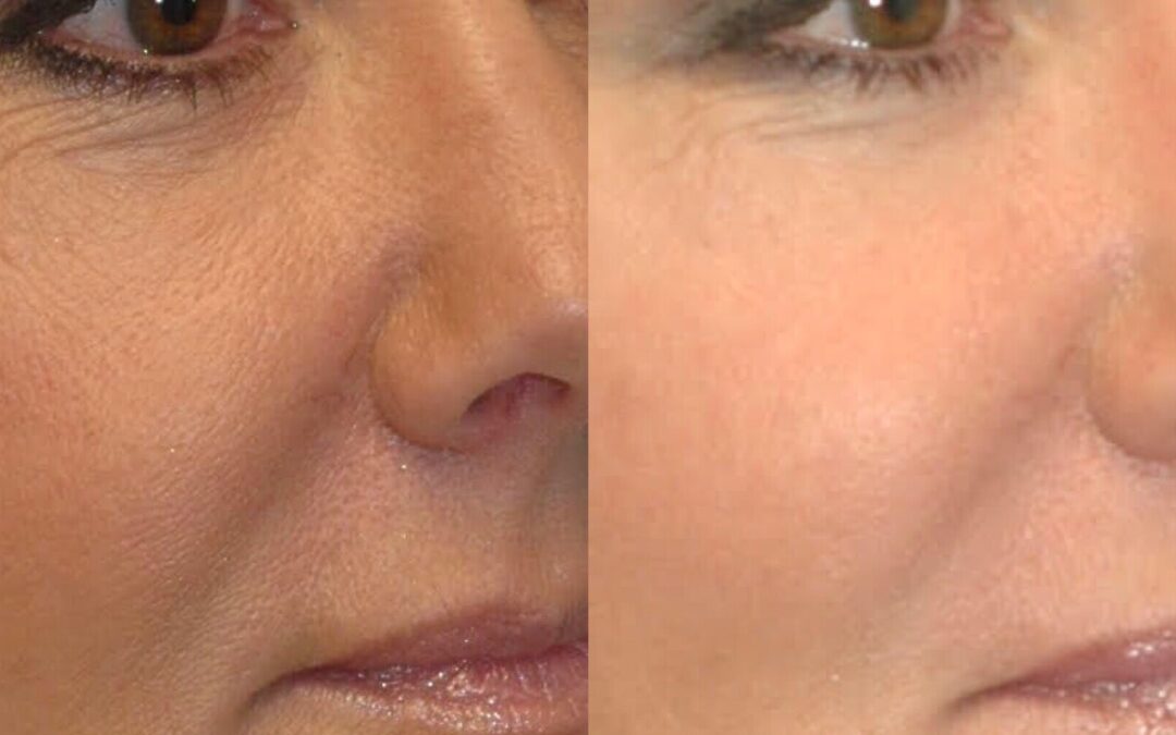 Mid Face Fillers