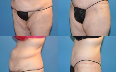 Circumferential Lower Body Lift