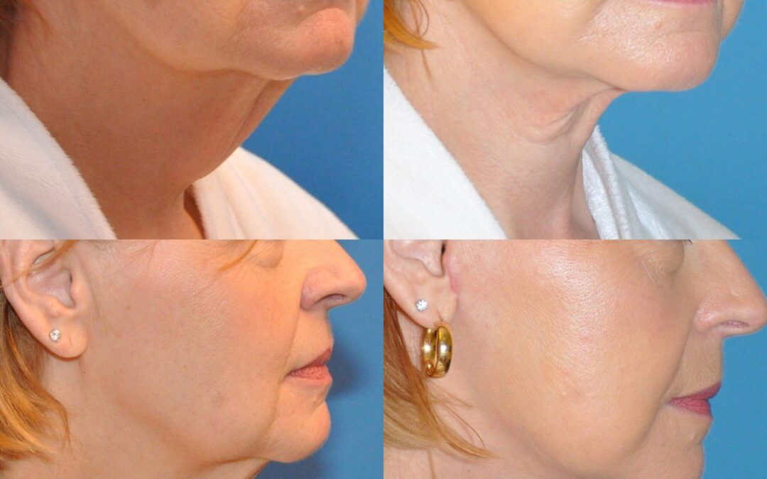 Neck Lift