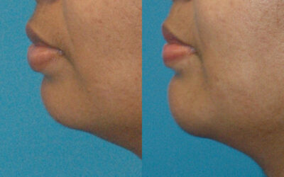 Chin Augmentation