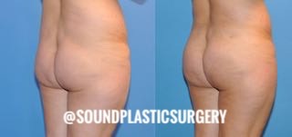 The Brazilian Butt Lift