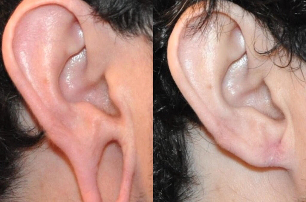 Earlobe Repair Surgery