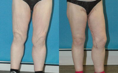 Thigh Lift Surgery