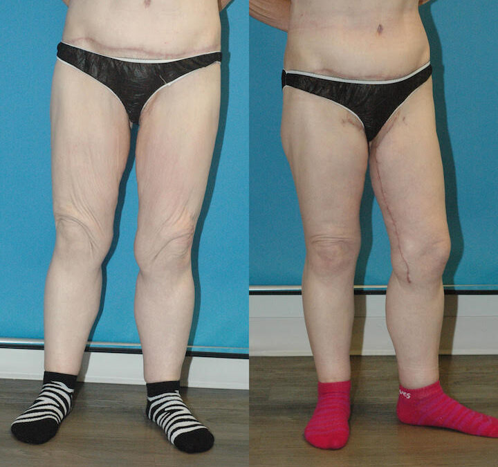 Thigh Lift Surgery
