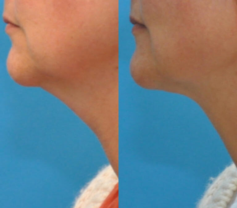 Kybella