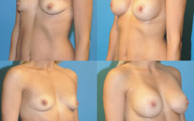Breast Aug Recovery