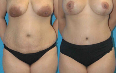 Mommy Makeover Results
