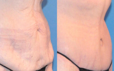 Lower Body Lift Results