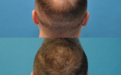 Hair Restoration with NeoGraft
