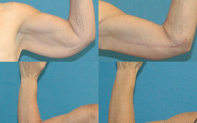 Brachioplasty (Arm Lift)
