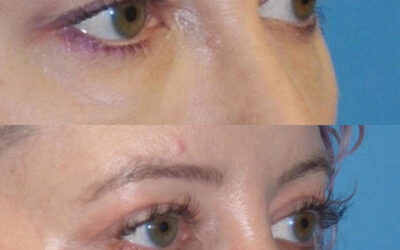 Brow Lift Surgery