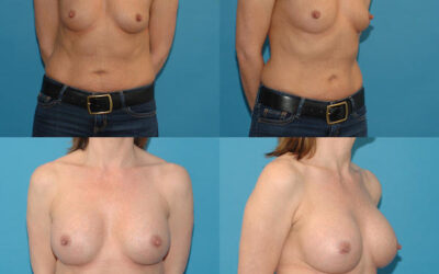 Patient Highlight- Breast Augmentation