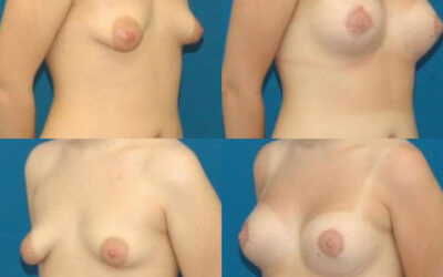 Tuberous Breast Correction
