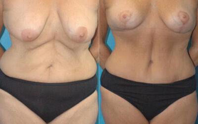 Tummy Tuck and Breast Lift
