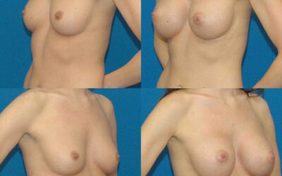 Ideal Structured Implants