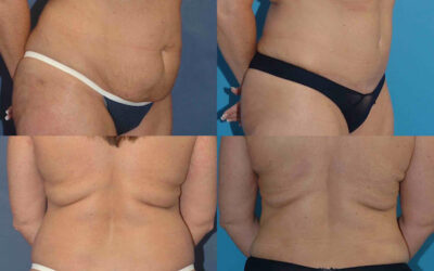 Mommy Makeover Patient