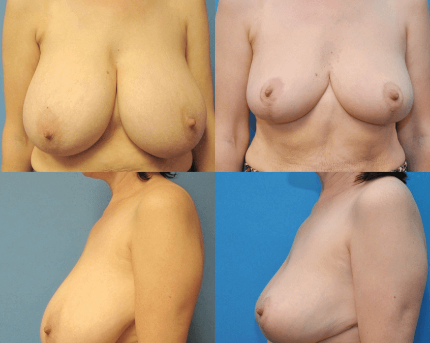 Reduction Mammaplasty
