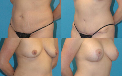 Mommy Makeover Highlight