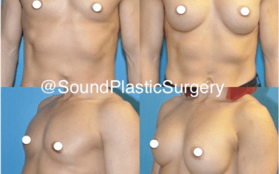 Breast Augmentation at Sound Plastic Surgery!