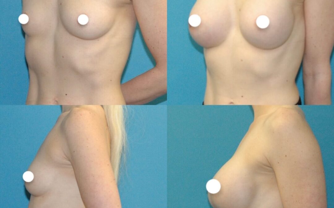 Combined breast augmentation and front bra roll liposuction.