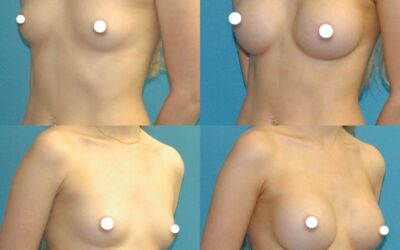 Breast Augmentation Procedure