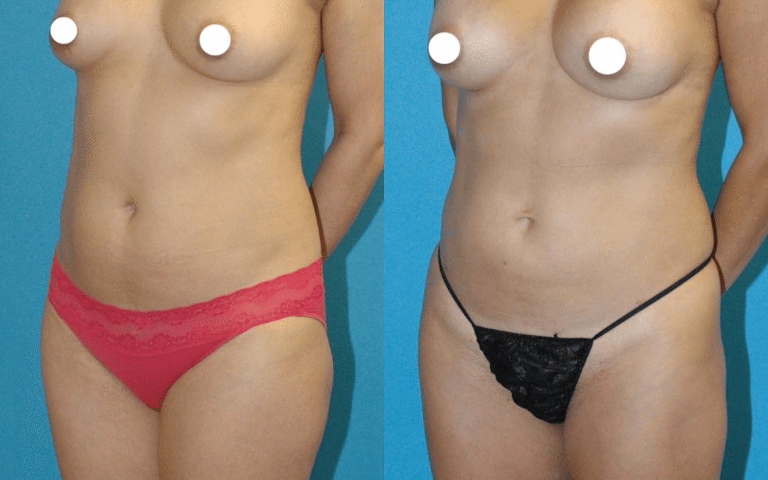 Breast Augmentation and Liposuction