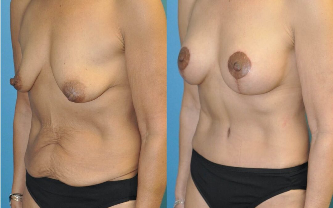 Mommy Makeover Results!