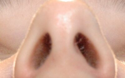 Rhinoplasty Incisions