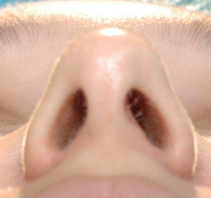 Rhinoplasty Incisions