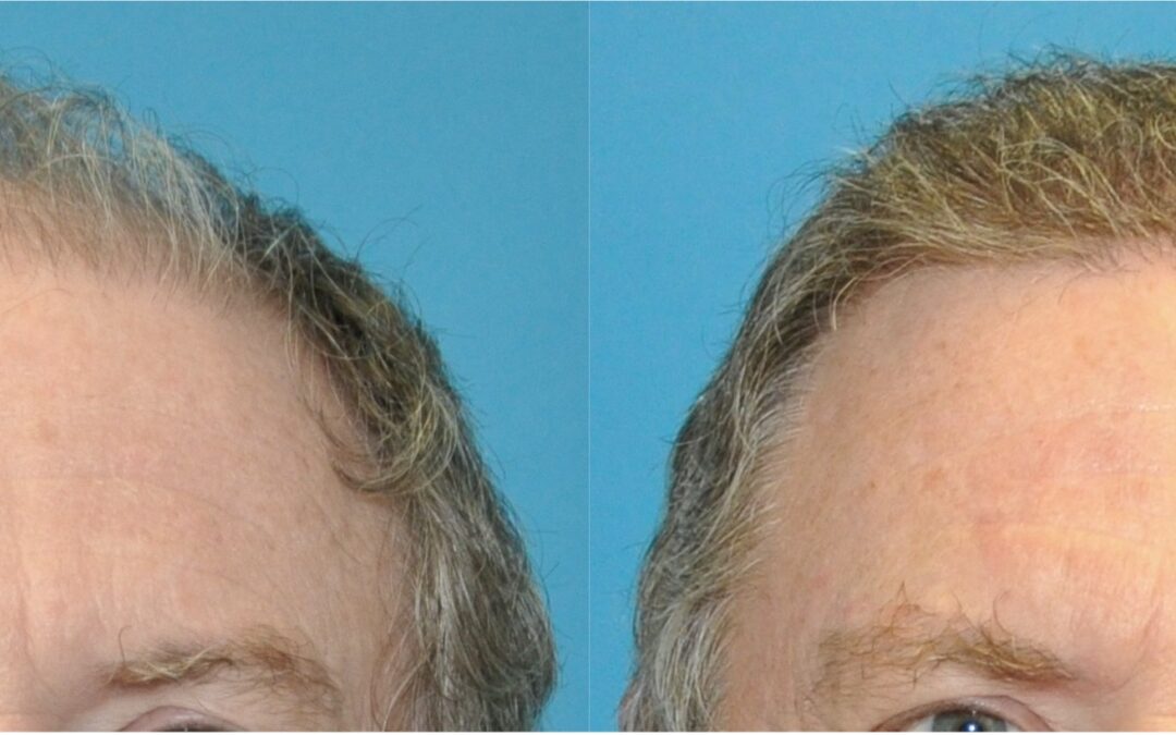 Amazing Hair Transplant Results at Sound Plastic Surgery!