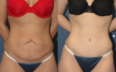 An amazing Mommy Makeover from the body contouring experts at Sound Plastic Surgery