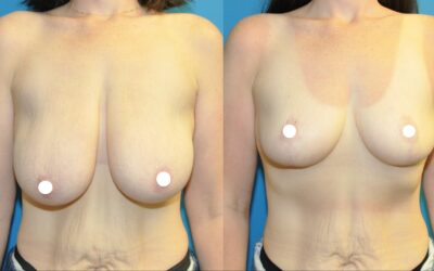 Breast Lift Results!
