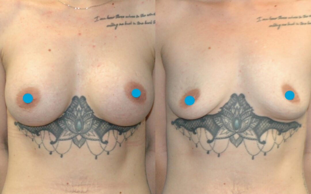 Breast Augmentation and Ink Integration!
