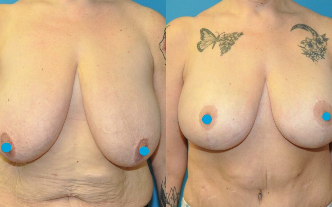 Amazing Breast Lift and Augmentation Results!