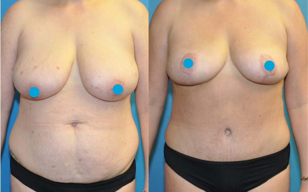 Stunning Mommy Makeover Results!