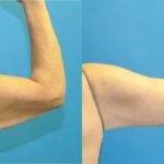 Arm Lift #1 - Before and After