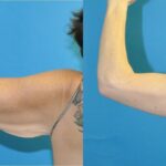 Arm Lift #1 - Before and After