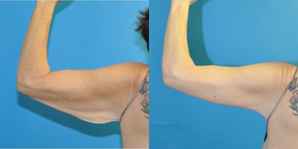 Arm Lift #1 - Before and After