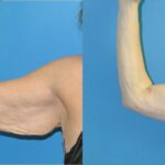 Arm Lift #1 - Before and After