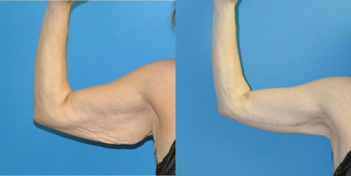 Arm Lift #1 - Before and After