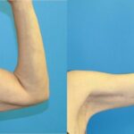 Arm Lift #1 - Before and After