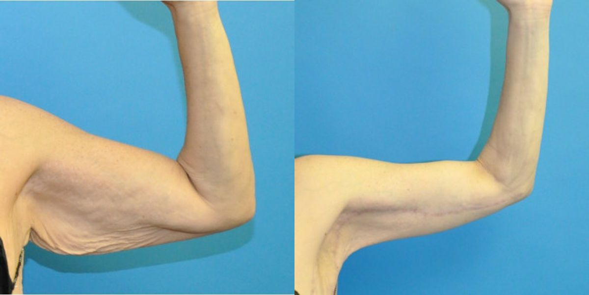Arm Lift #1 - Before and After