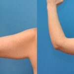 Arm Lift #2 - Before and After
